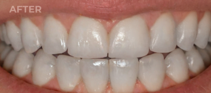 An UpWhiten client's teeth before and after one session — result 5 of 6