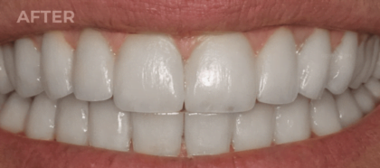 An UpWhiten client's teeth before and after one session — result 3 of 6