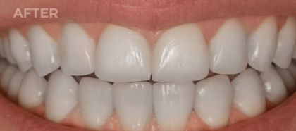 An UpWhiten client's teeth before and after one session — result 2 of 6