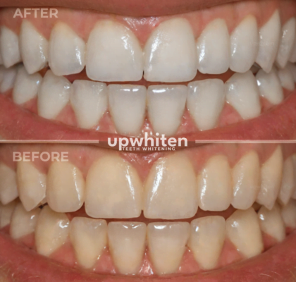 A before and after comparison of teeth whitening treatment in Ottawa, showing noticeably brighter teeth in the "after" photo compared to the discolored teeth in the "before" photo.