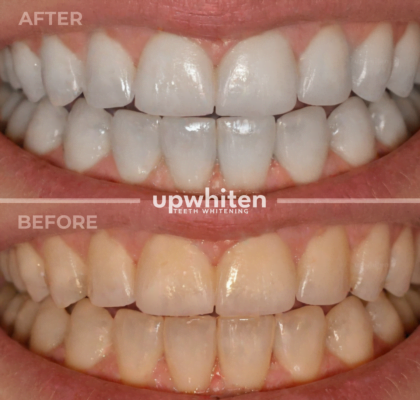 Before and after comparison of teeth whitening treatment in Ottawa, showcasing a significant improvement in tooth color and brightness.