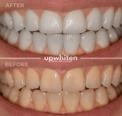 A before-and-after comparison of teeth whitening results in Ottawa, with visibly brighter and cleaner teeth in the "after" image.