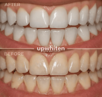 Before and after comparison of teeth whitening treatment in Ottawa, showcasing a significant improvement in the color and brightness of the teeth.